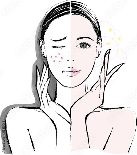 女性　頬のニキビ　ビフォーアフター
