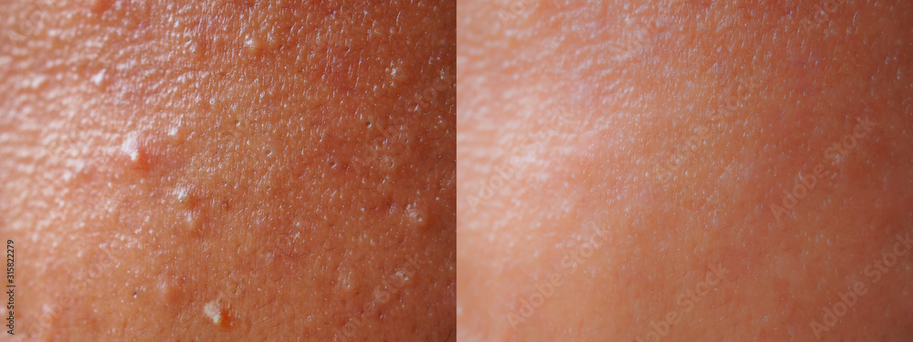 Fototapeta premium Closeup skin face texture before and after facial treatment problem of spot acne blackheads on forehead young Asian woman background.Problem skincare and beauty concept.