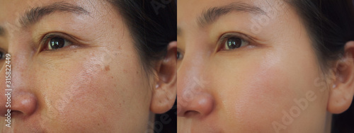 Fotografi Image before and after treatment rejuvenation surgery on face asian woman concept