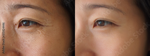 Image before and after treatment rejuvenation surgery on face asian woman concept. Closeup wrinkles dark spots pigmentation on facial female.