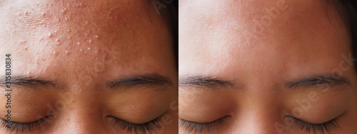 Image before and after acne treatment on the face of young Asian woman.Problem skin and beauty concept. photo