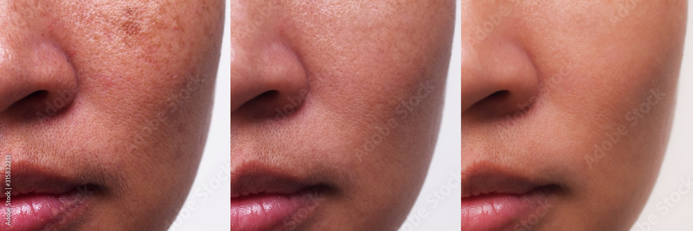 Image before and after facial treatment problem of skin dark spot melasma pigmentation on face of Asian womancompare in 3 periods.Beauty and healthcare concept. Image before and after facial treatment problem of skin dark spot melasma pigmentation on face of Asian womancompare in 3 periods.Beauty and healthcare concept.