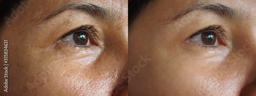 Image before and after treatment rejuvenation surgery on face asian woman concept.Closeup wrinkles dark spots pigmentation on senior female. photo