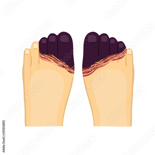 Frostbite toes and feet vector illustration on white background.