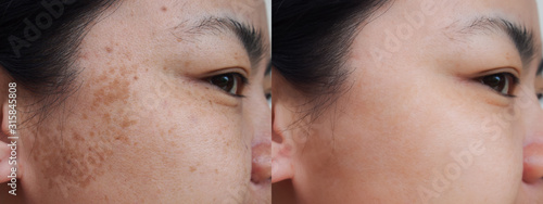 Closeup asian woman face before and after dark spot melasma pigmentation skin facial treatment.Problem skincare and health concept.