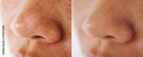 Image closeup before and after treatment small pimple acne blackheads on skin of  nose and spot melasma pigmentation  on facial Asian woman .Problem skincare and health concept.