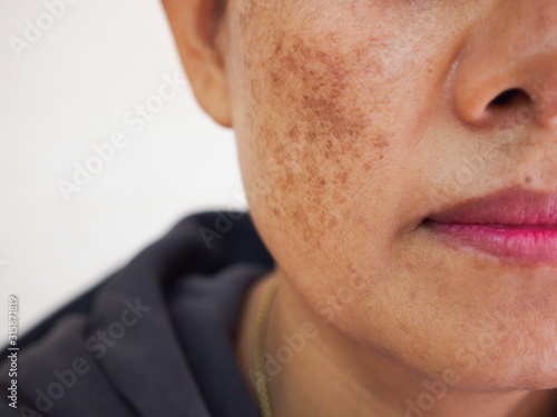 Problem skincare and health concept.Wrinkles,melasma,Dark spots,freckles,dry skin on face middle age asian woman. photo