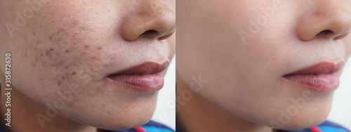 Foto Image before and after dark spot scar acne and melasma pigmentation skin facial treatment on face asian woman