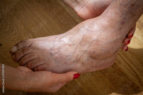 closeup feet of old man suffering from leprosy with a cane on the ground © mironovm