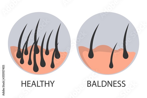 Hair loss stages set of before and after steps. Side view of a man losing hair before and after hair treatment and transplantation. number of hair on scalp before and after of treatment loss.