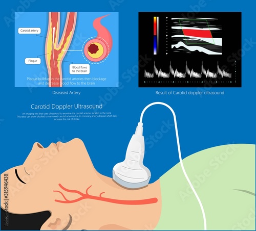 Carotid duplex doppler artery ultrasound disease diagnosis treatment photo