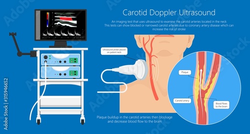 Carotid duplex doppler artery ultrasound disease diagnosis treatment