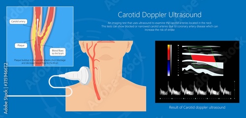 Carotid duplex doppler artery ultrasound disease diagnosis treatment