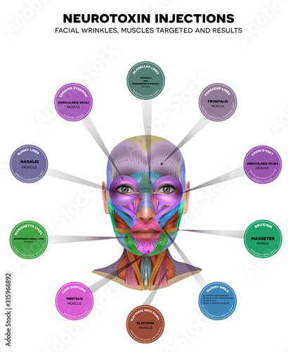 Injections for facial wrinkles. Common types of facial wrinkles. Neurotoxin injections treatment areas, muscles targeted and results. 