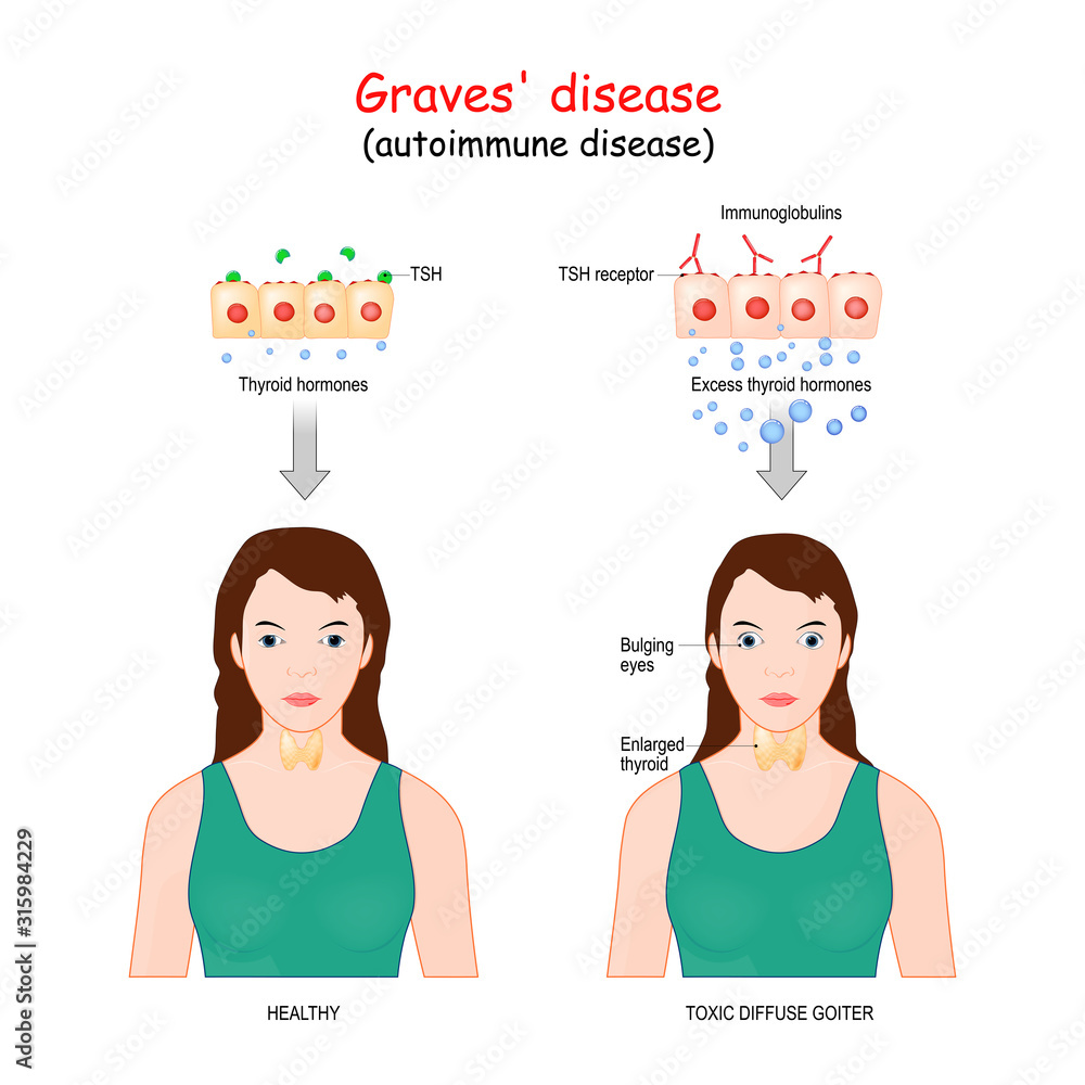 Graves' disease. toxic diffuse goiter is an autoimmune disease that affects  the thyroid Stock Vector | Adobe Stock