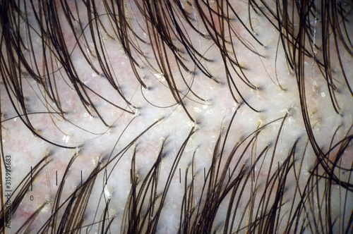 Scalp and hair with multiple exfoliation. Macroscopy of hair on the head with signs of peeling at hair follicles. Scalp dermoscopy. Hair treatment in the clinic.