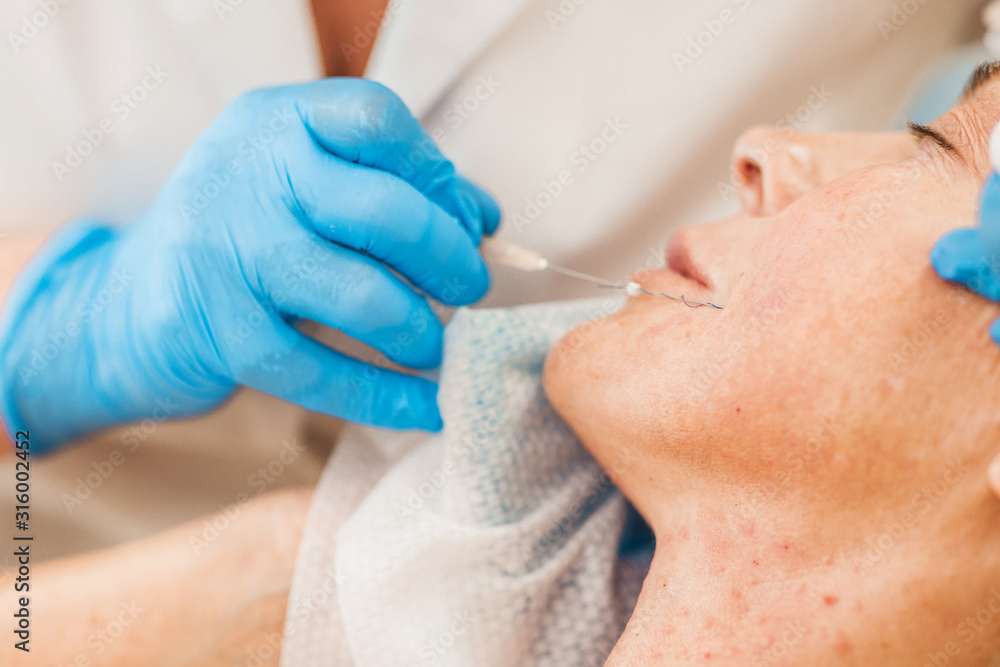 PDO Thread Lift is a treatment which lifts and tightens sagging skin tissue PDO Thread Lift is a treatment which lifts and tightens sagging skin tissue