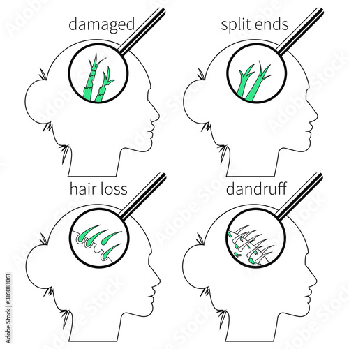 Hair problems set of line silhouette illustrations. Scheme for treatment products and package instructions. Split ends, damaged, dandruff and loss. Magnifying glass and woman with bun. Vector icons.