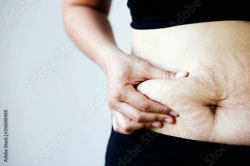 Foto Women after birth give rise to stretch marks and belly fat.