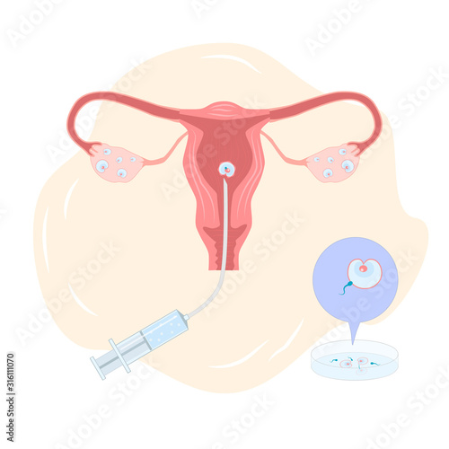 A fertilized egg is transplanted into the uterus. Artificial insemination - illustration
