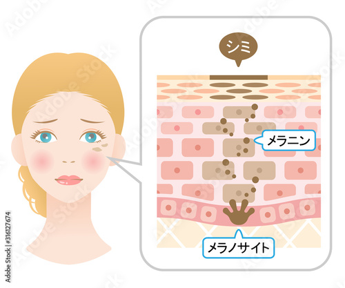 しみ　女性の顔と肌の断面図