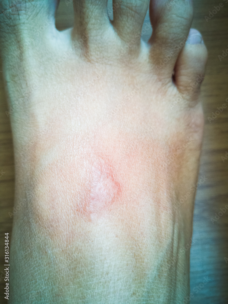skin rash due to marine coral poisoning, that is in the healing process