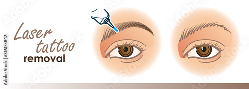 Eyebrow removal procedure illustration. Laser tattoo removal icons, microblading