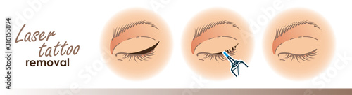 Eyeliner removal procedure illustration.Laser tattoo removal icons, microblading