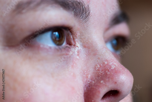 Psoriasis an der Nase und am Auge