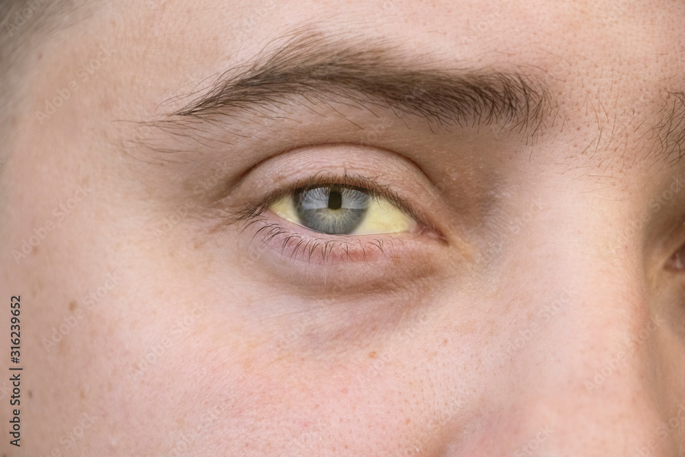 The yellow color of the male eye. Symptom of jaundice, hepatitis or problems with the gall bladder, gastrointestinal tract, liver. The yellow color of the male eye. Symptom of jaundice, hepatitis or problems with the gall bladder, gastrointestinal tract, liver.