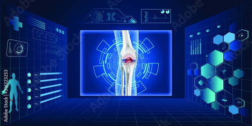 Treatment for knee osteoarthritis future medical scheme. Medications Administration with a syringe needle to damaged Joint and healthy Knee Anatomical.Vector illustration