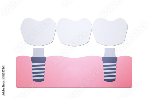 tooth implant with bridge, installation process and change new root for teeth - dental cartoon paper cut style
