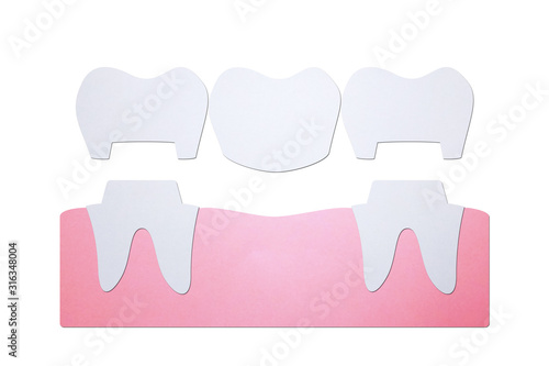 dental crown with bridge, installation process and change of teeth - tooth cartoon paper cut style