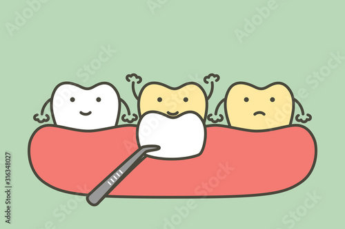 dental veneers installation procedure for tooth whiten - teeth cartoon vector flat style