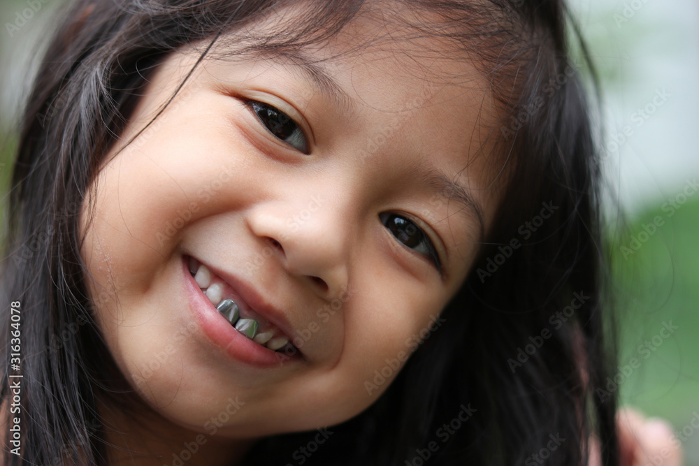 Asian little cute girl smiling with dental crown closed up the camera and her face dry skin in winter season Asian little cute girl smiling with dental crown closed up the camera and her face dry skin in winter season