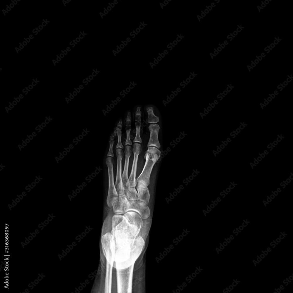 X-ray of foot on black background X-ray of foot on black background