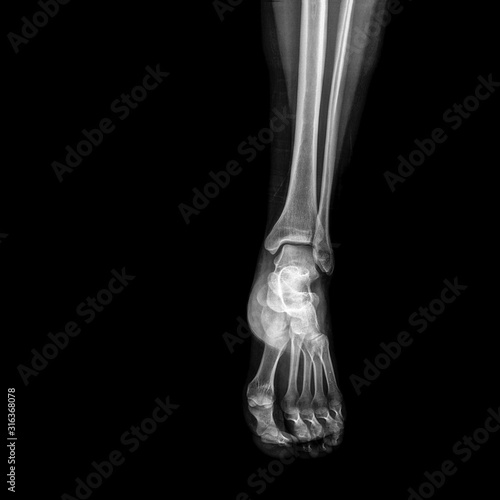 X-ray of foot on black background