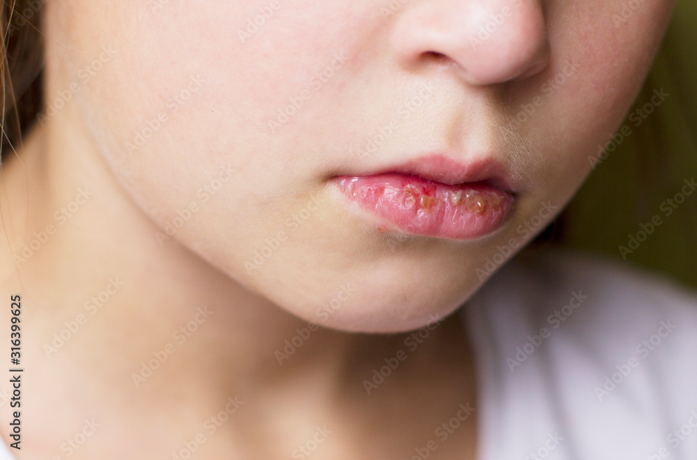 Obraz premium Herpes on the lips of a child