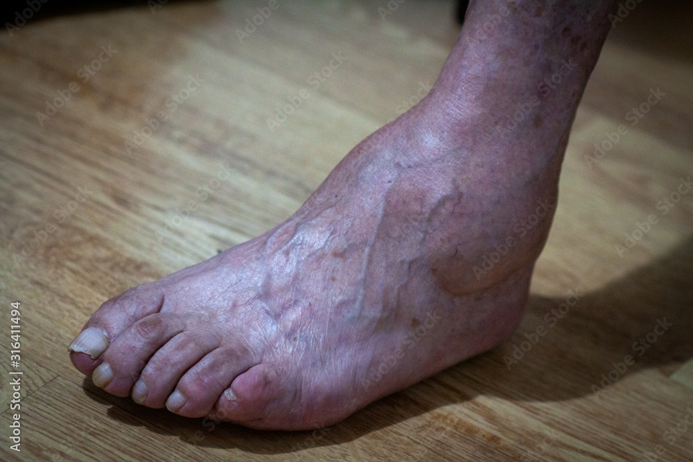 closeup feet of old man suffering from leprosy with a cane on the ground closeup feet of old man suffering from leprosy with a cane on the ground