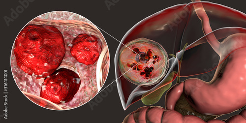 Hydatid cyst of Echinococcus granulosus in the liver