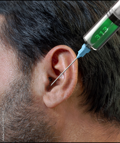Intratympanic injection for the treatment of subjective Tinnitus photo