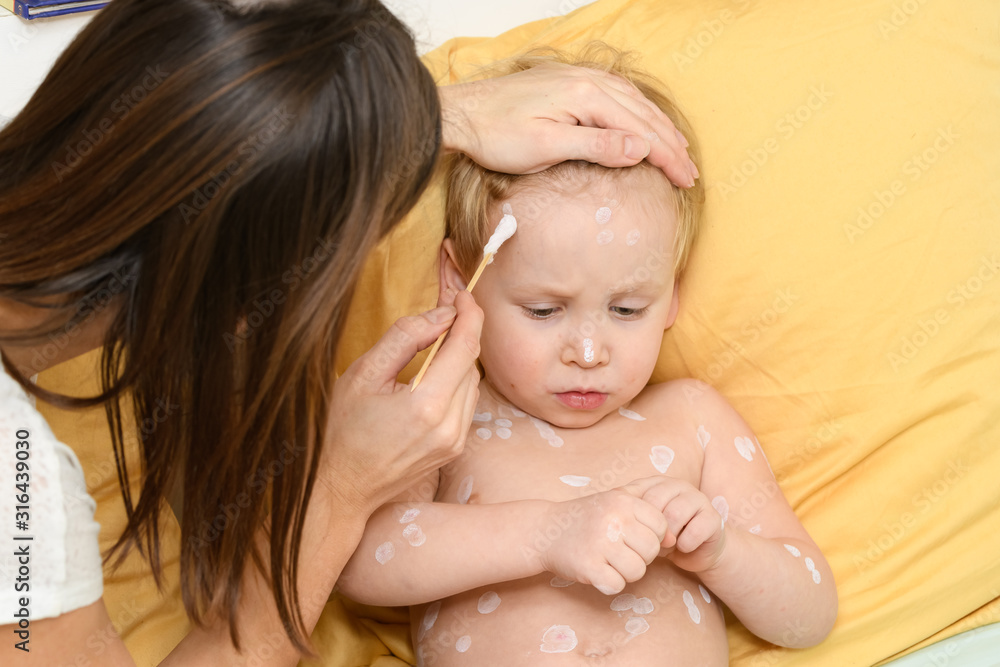 Varicella virus or Chickenpox bubble rash on boy Varicella virus or Chickenpox bubble rash on boy