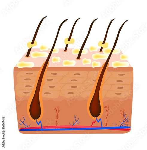 Seborrhea skin and hair. Dandruff seborrheic dermatitis. Dysfunction of the sebaceous glands. Inflammatory skin disease. Anatomical structure. Infographics. Vector illustration on isolated background.