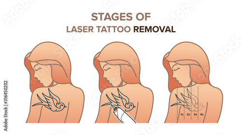 Stages of laser tattoo removal. Vector illustration