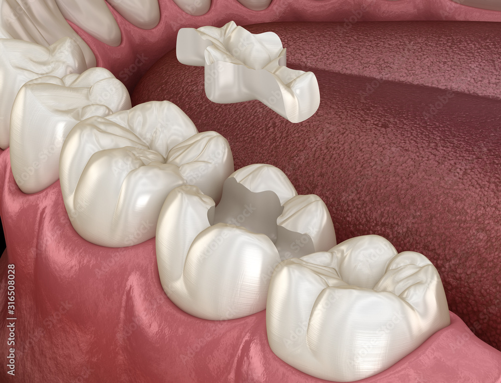 Inlay ceramic crown fixation over tooth. Medically accurate 3D