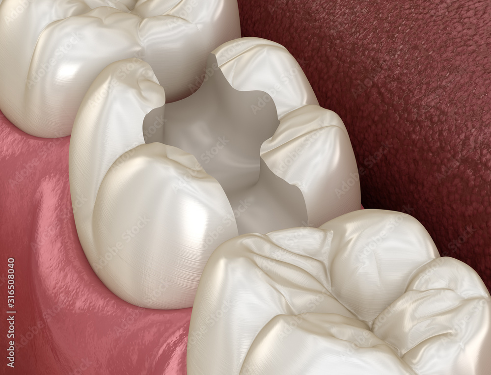 Tooth preparation for inlay placement. Medically accurate 3D illustration of human teeth treatment Tooth preparation for inlay placement. Medically accurate 3D illustration of human teeth treatment