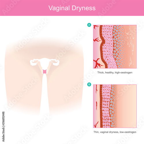 Vaginal Dryness. The vaginal tissue layers area thin and dryness when volume oestrogen hormone it's reduced. Illustration healthcare and medicine..