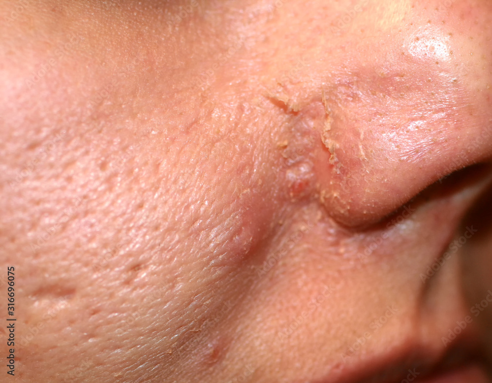 Inflamed skin on the face. Acne. Pimples on the skin. Scars and peeling. Inflamed skin on the face. Acne. Pimples on the skin. Scars and peeling.