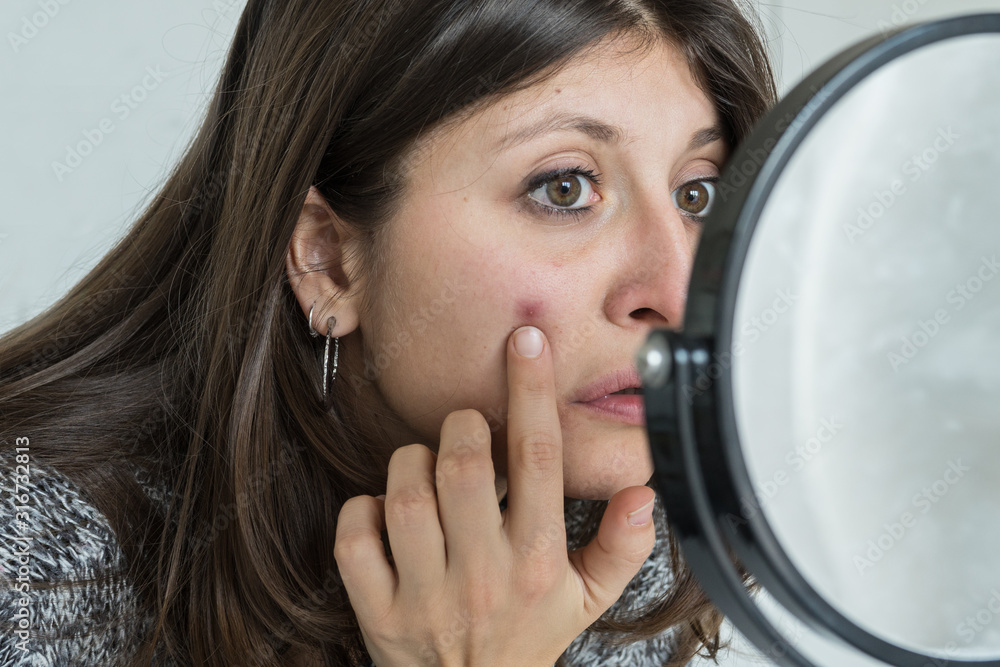 Young woman looks worried in the mirror at the pimple on her face Young woman looks worried in the mirror at the pimple on her face