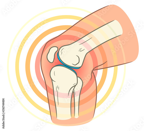 Knee joint pain